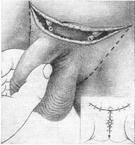 通过拉出隐藏的部分来延长阴茎的手术长度